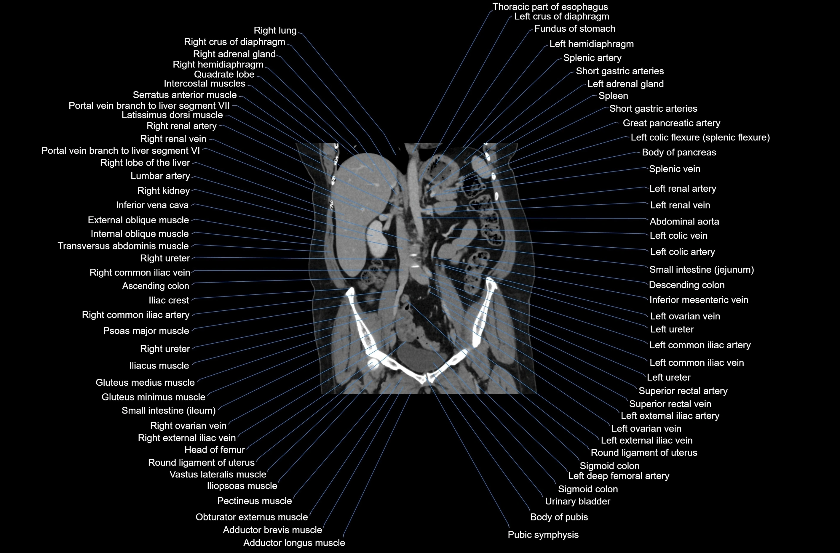 CT abdomen coronal cross sectional anatomy labelled radiology image-00047.webp